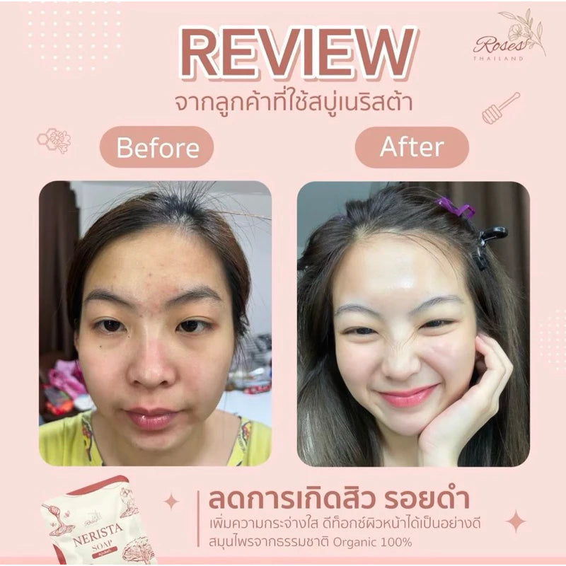 Before and after results showing clearer brighter skin after 4 weeks of daily Nerista Face Soap use for acne treatment