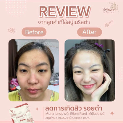 Before and after results showing clearer brighter skin after 4 weeks of daily Nerista Face Soap use for acne treatment